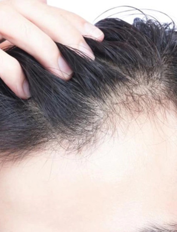 Rụng Tóc Tập Trung Phần Trán ( 90 Phút)